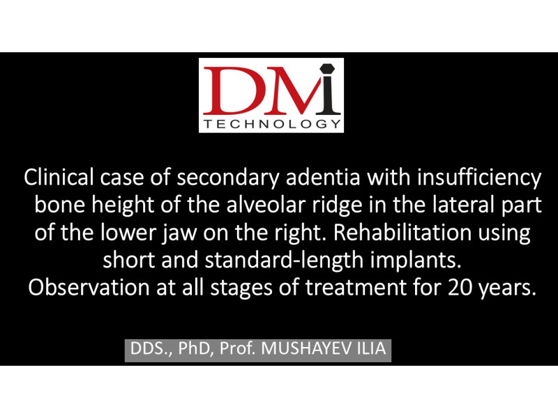 Using short implants in the lower jaw - All stages of treatment over 20 years