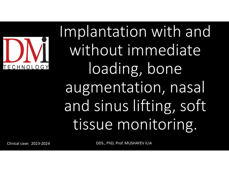Dental implantation with & without Immediate Loading, Nasal and Sinus Lifting