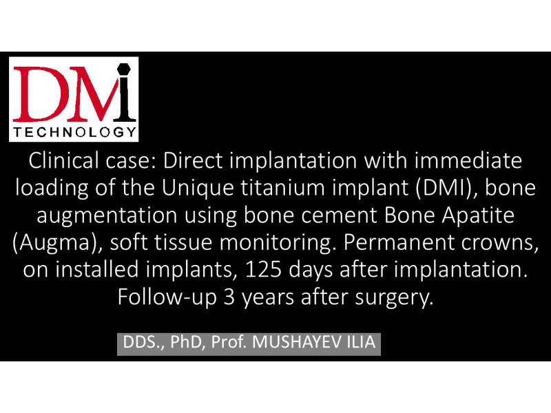 Direct implantation with Immediate Loading - UNIQUE implant