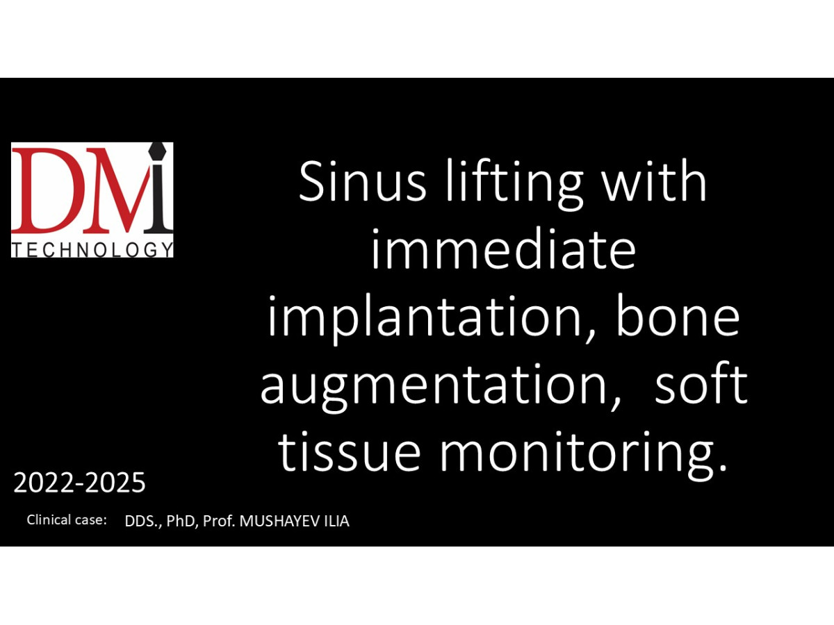 SINUS LIFTING - immediate implantation, bone augmentation, soft tissue monitoring