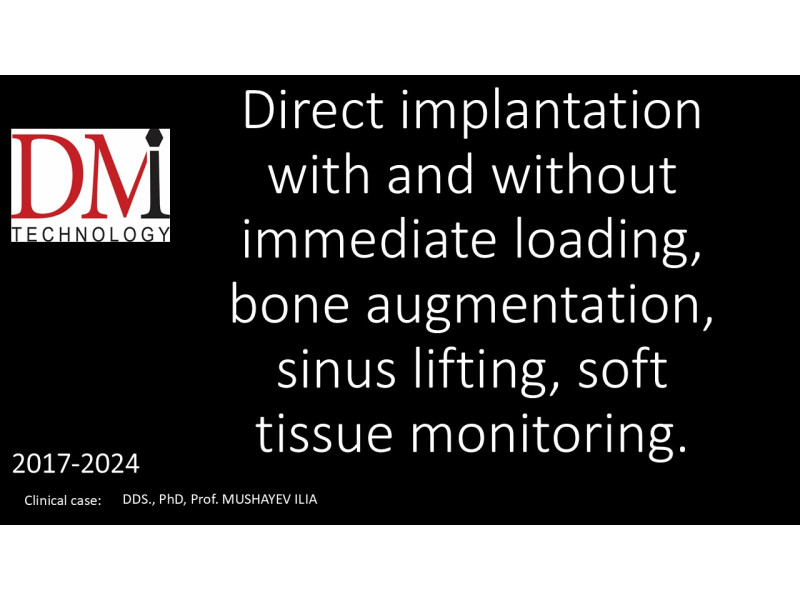 Direct implantation with immediate loading & FOLLOW-UP 7 YEARS AFTER SURGERY