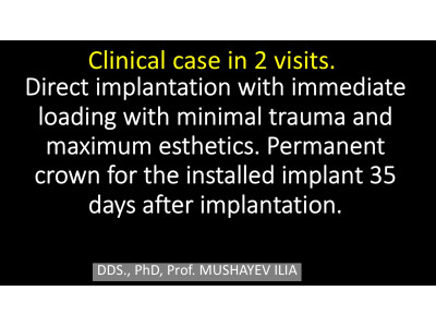 2 VISITS: Direct implantation with min trauma and max aesthetics + Crown