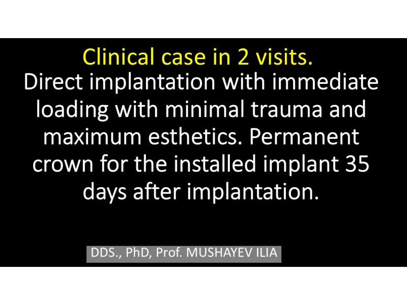 2 VISITS: Direct implantation with min trauma and max aesthetics + Crown