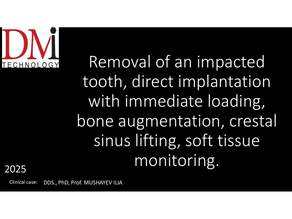 Tooth extraction, direct implantation with immediate loading, bone augmentation, crestal sinus lifting