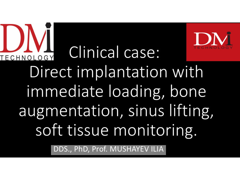 Direct implantation: Immediate Loading, Bone Augmentation, Sinus Lifting