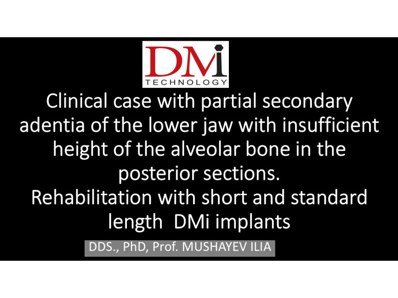 Restoration of teeth in case of bone insufficiency in the jaw - Short and standard DMi implants