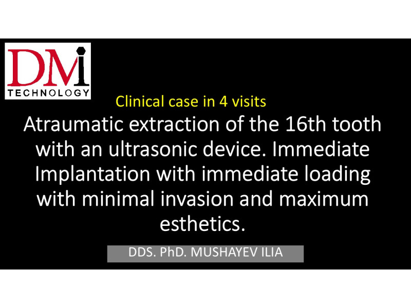 Atraumatic extraction of the 16th tooth, immediate implantation
